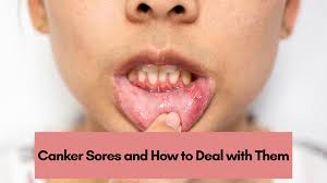 canker sores and how to deal with them