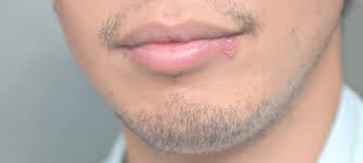 herpes simplex cure in bellevue