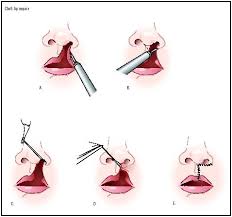 cleft lip repair procedure recovery