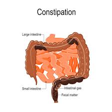 constipation and pelvic floor health
