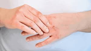 the implications of having eczema dr