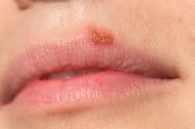 herpes triggers diagnosis