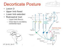 decorticate posture cause symptoms