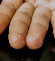 fingertip ling causes remes and