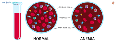 sickle cell anemia its symptoms