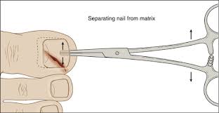 nail bed laceration anesthesia key