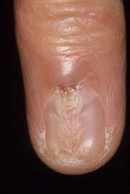 glomus tumor finger continuing