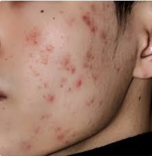 how to get rid of acne scabs nowpatient