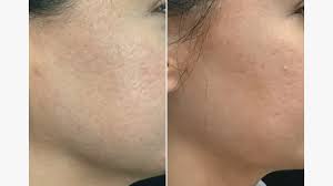 fillers for acne scars procedure cost