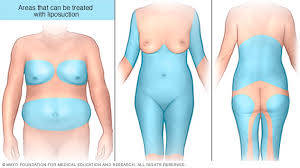It's a very good place to hide for both teams. Liposuction Treatment Areas Mayo Clinic
