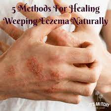healing weeping dermais naturally