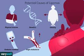 lipoma symptoms causes diagnosis