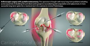 should i have meniscus surgery reviews
