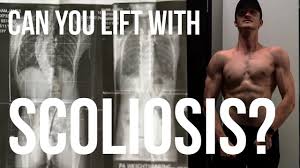 exercise with scoliosis spinal fusion