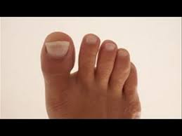 how to remedy yellow toenails you