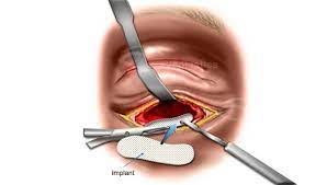 dr mazow cosmetic eyelid surgery