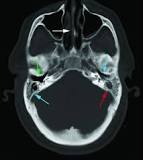 Image result for icd 10 code for bilateral mastoid effusions