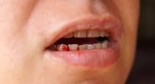 bleeding gums in pregnancy babycentre