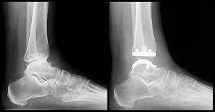 ankle replacement surgery how it works