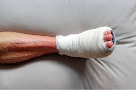 how to reduce swelling after bunion surgery