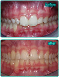How braces correct overbites is the subject we at spilsbury orthodontics would like to discuss today. Leader In Us Quality Dental Braces Tourism In Nuevo Progreso Mexico Meet Us Patient Info Treatments Braces Article Contact Us Treatment Orthodontic Preventive Care Treatment For Children Treatment For Adults Teeth And Face Classifications Tmj