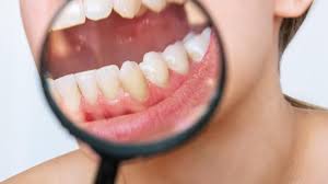 home remes to get rid of tartar in teeth