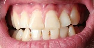 Zahnstein bildet sich vor allem an den stellen im mund, an denen als laie sollten sie keinesfalls versuchen, mit irgendwelchen werkzeugen an ihren zähnen zu kratzen. Zahnstein Entfernen Lassen Apotheken Umschau
