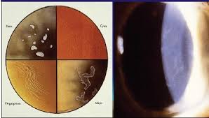 Corneal anterior basement membrane dystrophy: Map Dot Fingerprint Dystrophy