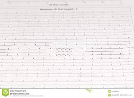 Ekg Chart Cardiac Arrhythmia On Paper Stock Image Image Of