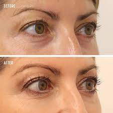 dermal filler injections the cosmetic