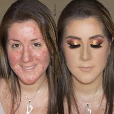 viral acne makeup tutorial causes