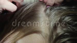 Is this the most extreme case of head lice ever? Treatment Of Head Pediculosis In A Child Removal Of Nits And Lice In The Girl S Hair Stock Video Video Of Child Hair 141752069