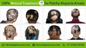patchy alopecia areata