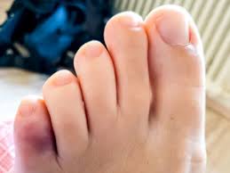 how to treat a sprained toe tips and