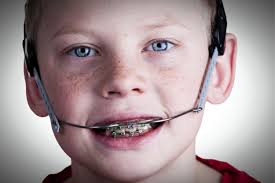 An underbite is also referred to as mandibular prognathism or a class iii. Orthodontic Headgear How It Works Side Effects Cost And Other Faqs