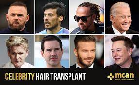 celebrity hair transplants and their
