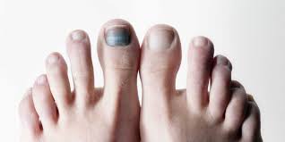 your guide to black toenails and how to