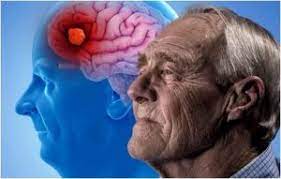 Ensayo clínico de novedoso medicamento para el tratamiento del Alzheimer leve o moderado comienza hoy en cuba - Infomed Santiago