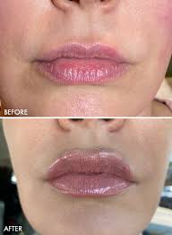 lip filler birmingham lip enhancement