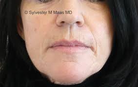 Volle lippen und reduzierte falten sind das schönheitsziel vieler patienten. Vorher Nachher Lippen Unterspritzung Hyaluron Maas Aesthetics Zug Maas Aesthetics