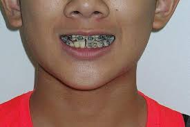 In a nutshell, it is a jaw widener. Dentist Pulled Out Boy S Four Teeth Unnecessarily Singapore News Top Stories The Straits Times