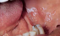 mouth sores and spots specialized