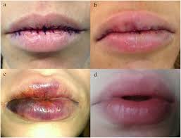 permanent implants for lip augmentation