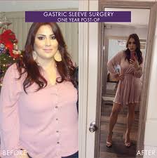 body after weight loss surgery