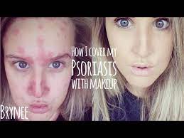 how i cover my psoriasis with make up