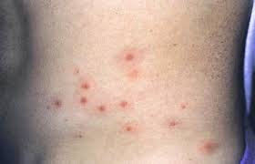 Melioidosis is a bacterial disease that affects humans and many species of animals. Melioidosis Singapore Pdf Ppt Case Reports Symptoms Treatment