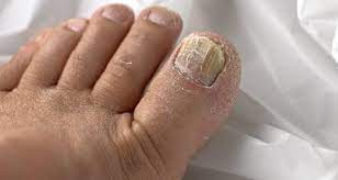 top 5 home remes for toenail fungus