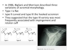 The acromion is a continuation of the scapular spine, and hooks over anteriorly. Bigliani Type 2 Acromial Morphology
