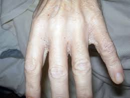 scabies symptoms pictures and