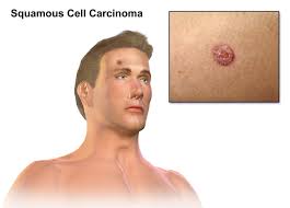 squamous cell carcinoma symptoms and